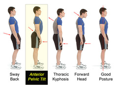 Fixing Anterior Pelvic Tilt: Posture tricks to make your butt and gut smaller